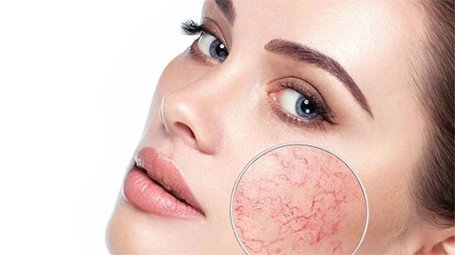 Фото В центре внимания - купероз